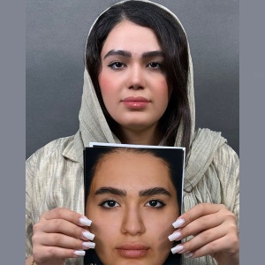 Rhinoplasty-61