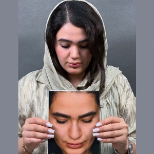 Rhinoplasty-62