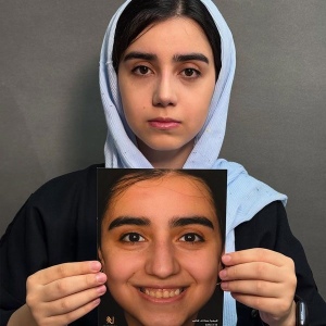 Rhinoplasty-65