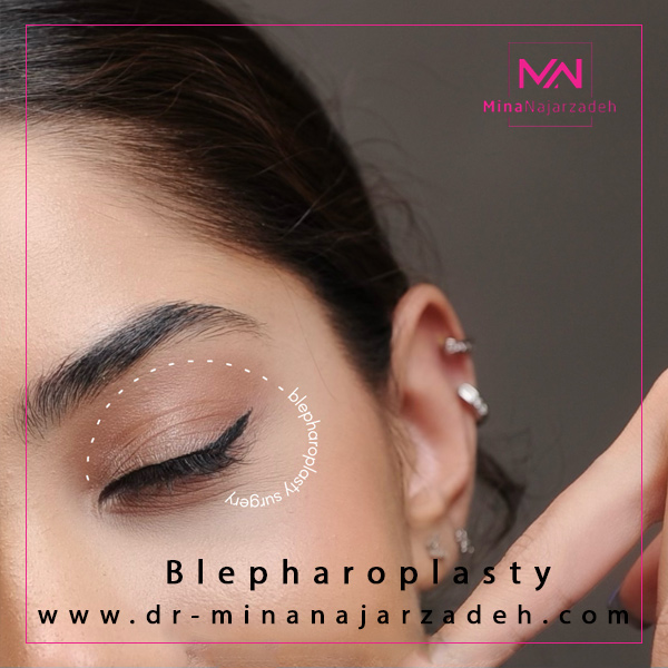 جراحی پلک در اصفهان -دکتر مینا نجارزاده