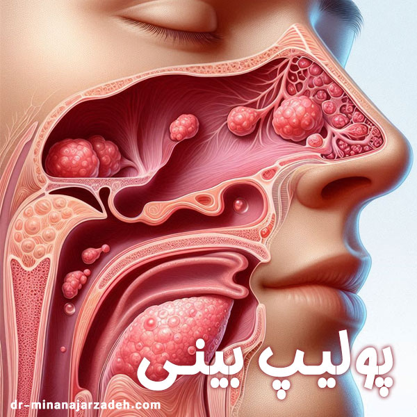 پولیپ بینی - دکتر مینا نجارزاده