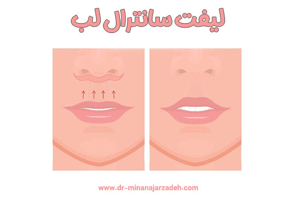 لیفت سانترال لب در اصفهان - دکتر مینا نجارزاده 
