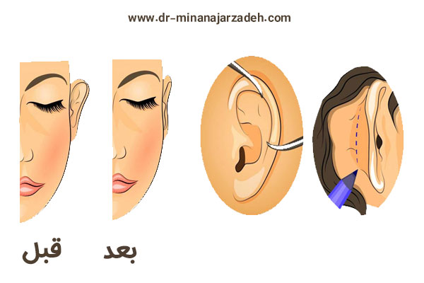 جراحی گوش در اصفهان + دکتر مینا نجارزاده