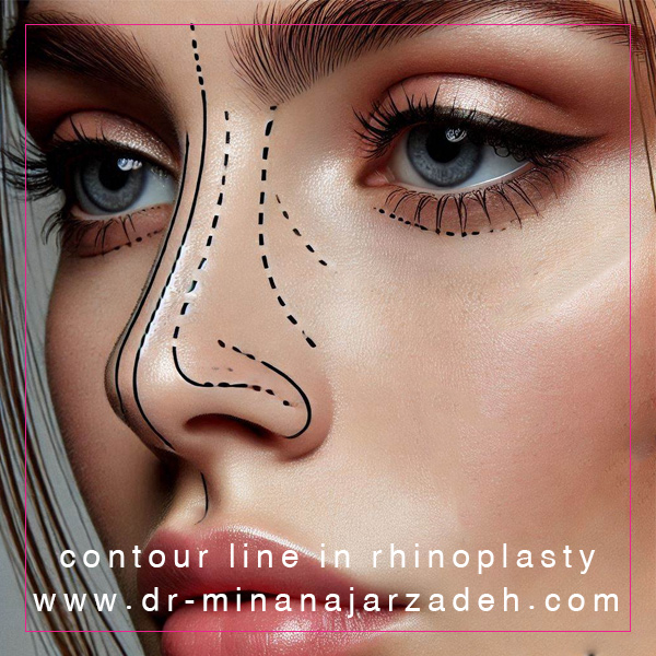 خط کانتور در جراحی بینی + دکتر مینا نجارزاده