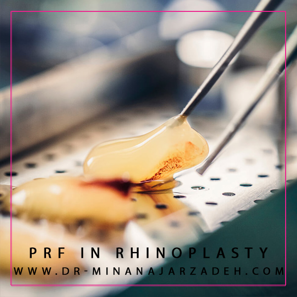 PRF در جراحی بینی + دکتر مینا نجارزاده