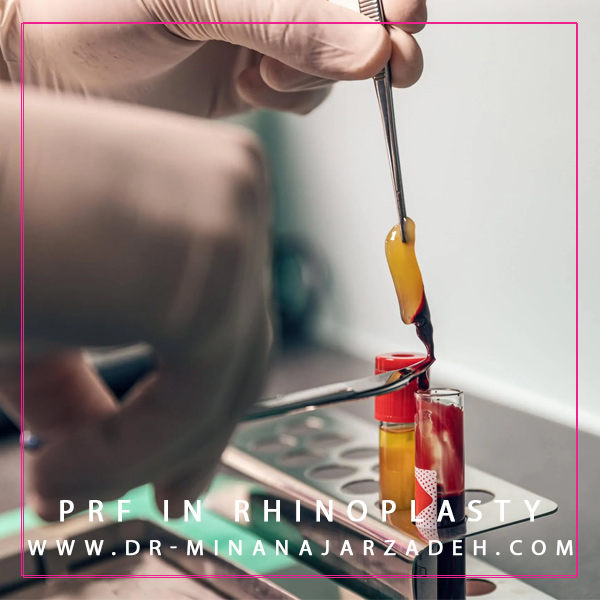 PRF در جراحی بینی + دکتر مینا نجارزاده