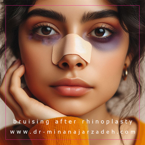 کبودی بعد از عمل بینی + دکتر مینا نجارزاده