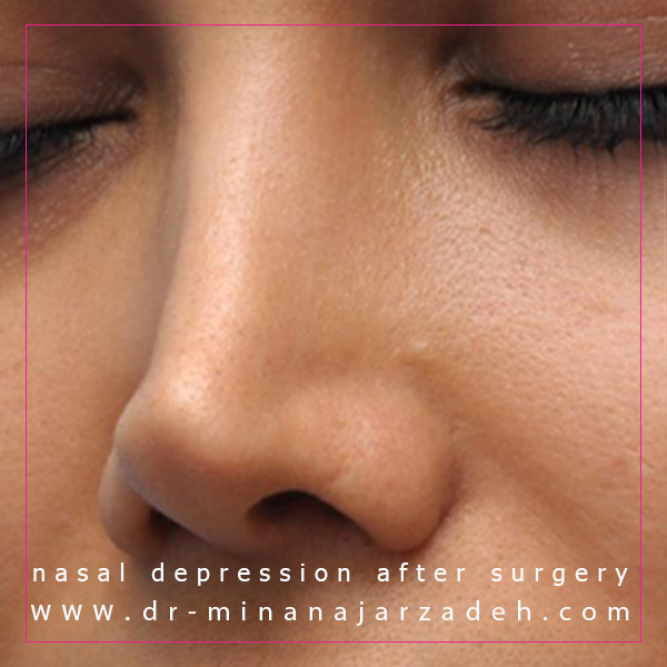 فرورفتگی بینی بعد از عمل + دکتر مینا نجارزاده